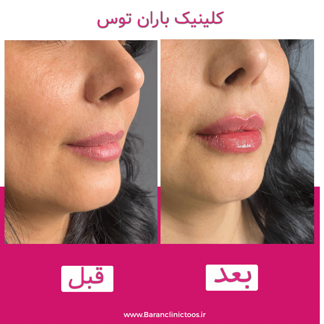 قبل و بعد فیلر لب